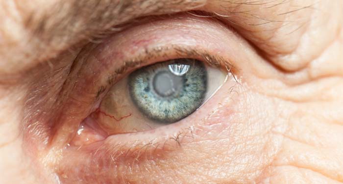 Cataracts: Not the end of the world